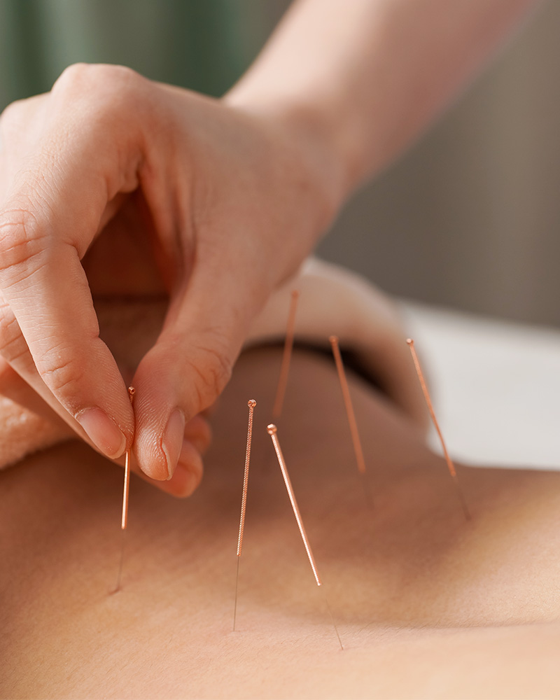 Acupuncture | Trillium Acupuncture